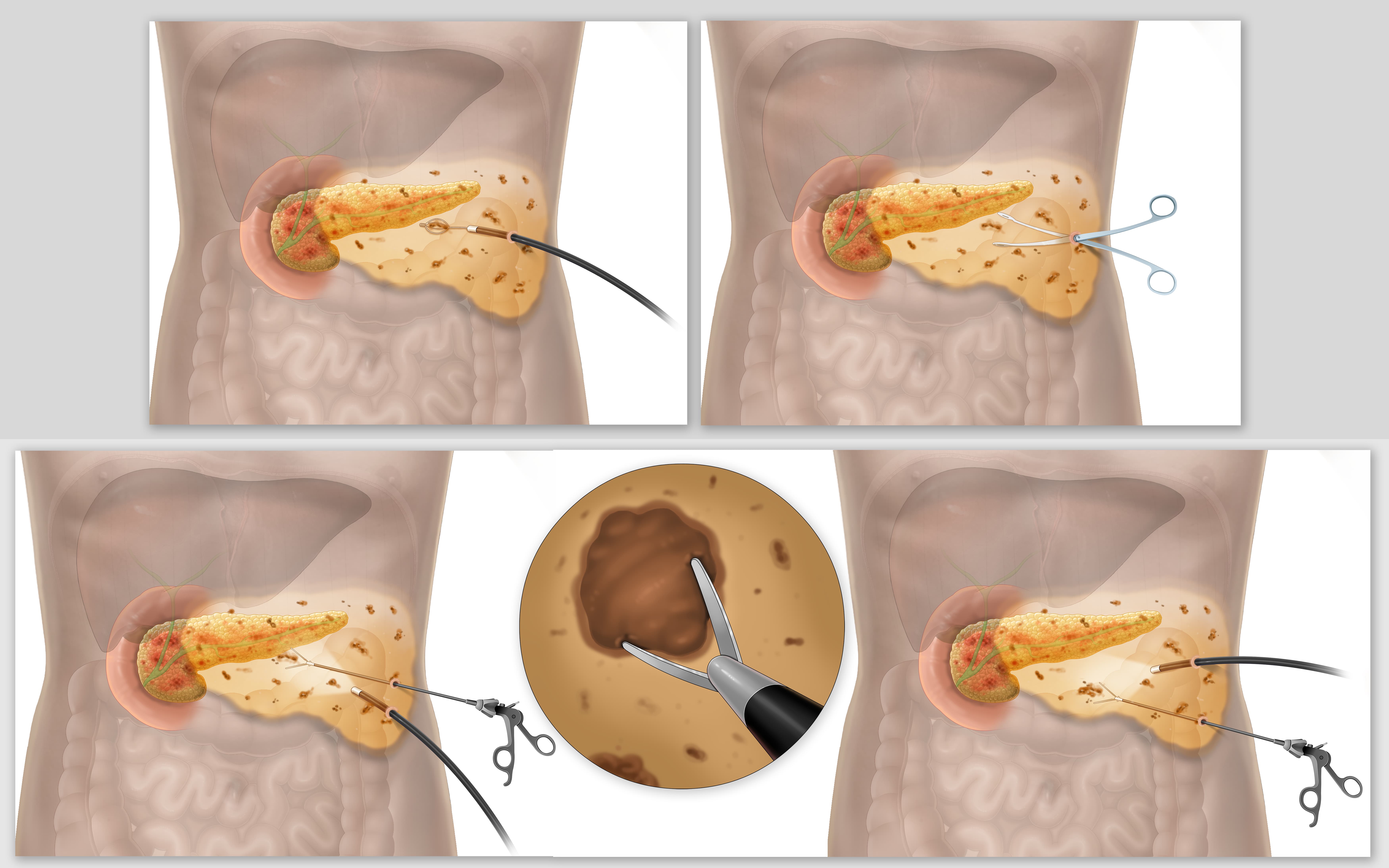 Step-by-step medical illustration of endoscopic pancreatic stone removal procedure for surgical education